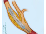 carotid_stenting.jpg