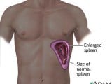 enlarged-spleen.jpg