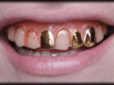 sc-CT230-PI-goldteeth.jpg