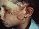 radiation-poisoning-from-the-ringworm-children-documentary.jpg