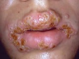 herpes-mouth.jpg