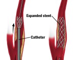 mcdc7_carotid_stenting.jpg