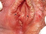 HPV-Vaginal.jpg