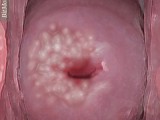 cervical_hpv.jpg