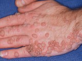 HPV-Warts-3.jpg