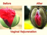 017-Vaginal-Rejuvenation.jpg