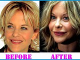 Meg-Ryan-facelift-before-after.jpg