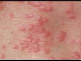 202stds-s3-photo-of-scabies.jpg