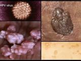 201stds-s1-photo-of-genital-warts.jpg