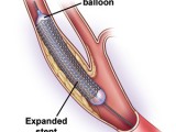 carotid stent.jpg