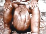 33_Elephantiasis.jpg